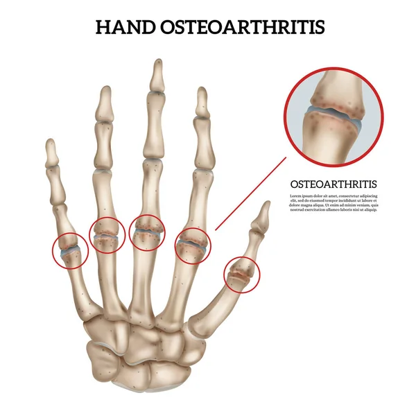 現実的な手変形性関節症の解剖学的インフォグラフィック白い背景ベクトル図 — ストックベクタ
