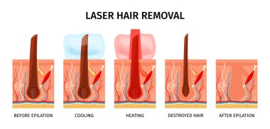 Lazer temizleme prosedürü illüstrasyonu sırasında kafa derisi görüntülerinin izole edildiği gerçekçi lazer tüy temizleme bileşimi