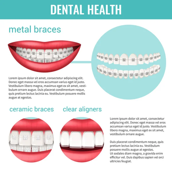 Dental Health Infographics Set Metal Ceramic Braces Realistic Vector Illustration — Stock Vector