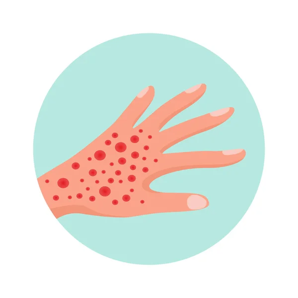 Allergie Symptom Flaches Symbol Mit Hand Bedeckt Mit Allergischem Roten — Stockvektor
