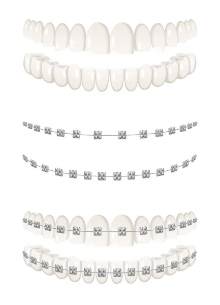 Teeth Dental Braces Realistic Icons Set Isolated Vector Illustration — Stock Vector