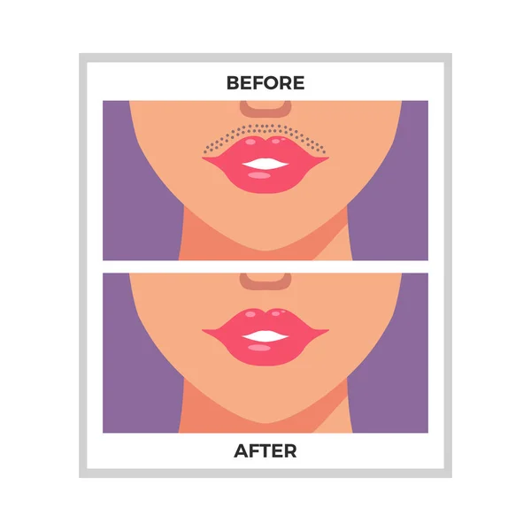 Zone Des Lèvres Avant Après Épilation Illustration Vectorielle Plate — Image vectorielle