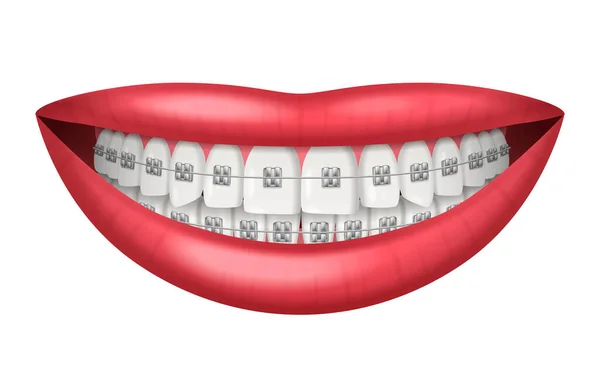 Teeth Dental Braces Realistic Isolated White Background Vector Illustration — Stock Vector