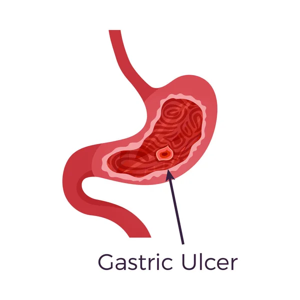 Úlcera Gástrica Enfermedad Estomacal Vector Plano Ilustración — Vector de stock