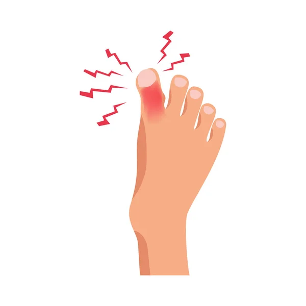 痛みを伴うつま先傷害上の人間の足フラットベクトルイラスト — ストックベクタ