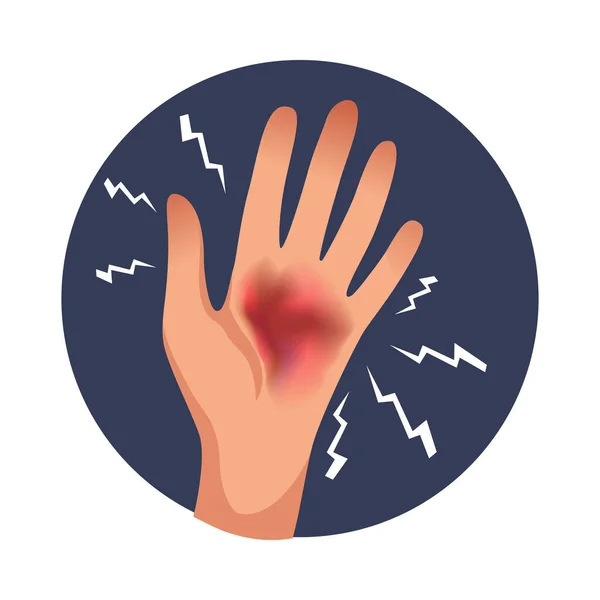 Painful Hand Burn Flat Icon Vector Illustration — Stock Vector