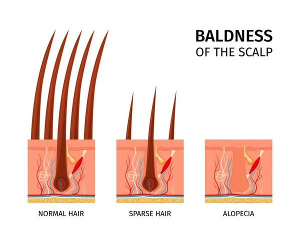 Metin Başlıklarıyla Gerçekçi Saç Yapısı Bileşimi Normal Seyrek Saç Alopecia — Stok Vektör