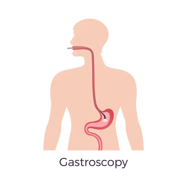 Gastroscopy Diagnosa Pemeriksaan Konsep Vektor Ilustrasi Datar - Stok Vektor