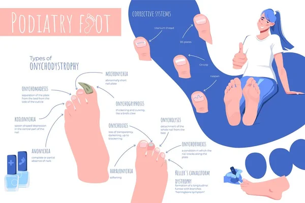 ポディアトリーフット病 人間の足の画像のフラットインフォグラフィック構成 編集可能なテキストキャプションと矢印ポインターベクターのイラスト — ストックベクタ
