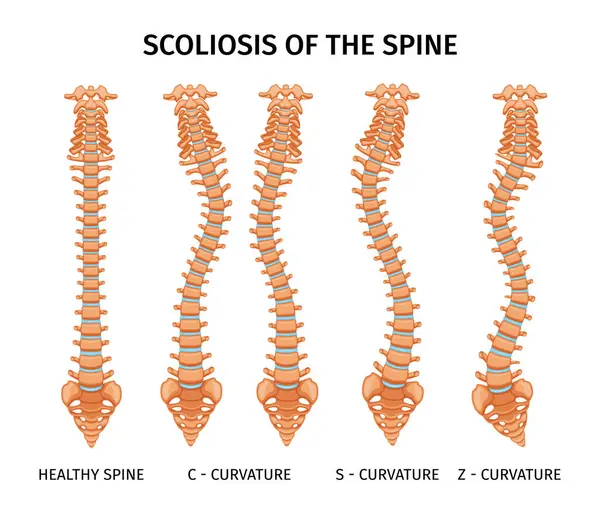 空白の背景ベクトルイラストに単離された脊椎曲率画像セットの脊椎インフォグラフィックの脊柱側弯症の種類 — ストックベクタ