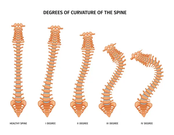脊椎の曲率のさまざまな程度を示す孤立したアイコンの脊椎構造解剖学セット 健康で病気のベクター図 — ストックベクタ