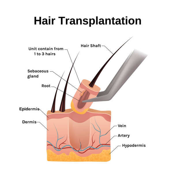Realistic hair transplantation infographic template
