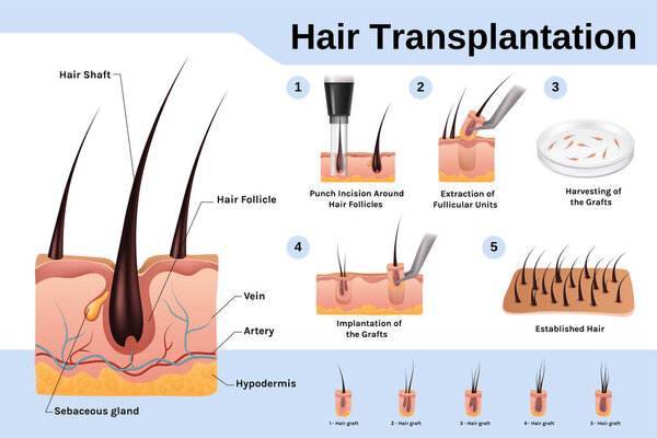 Realistic hair transplantation infographic template