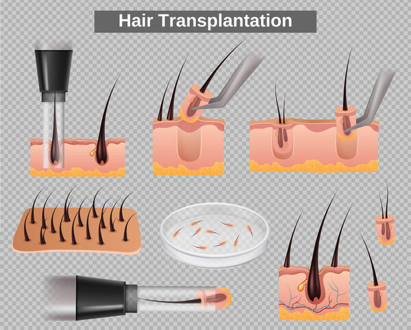 Realistic hair transplantation element set on transparent background