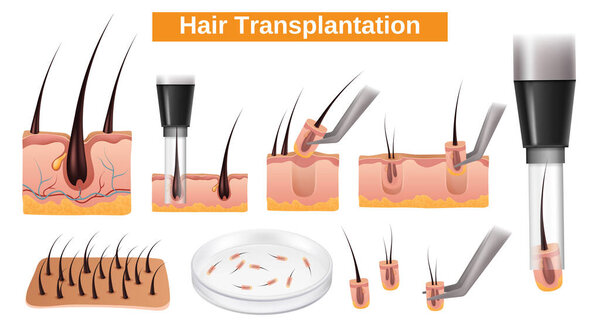 Realistic hair transplantation element set collection