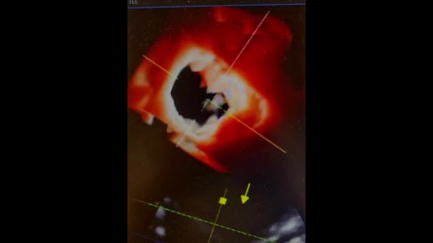 食管经食管Echo显示二尖瓣反流 — 图库视频影像