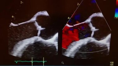 Doppler ECHO of aortic valve showing flow jets in color