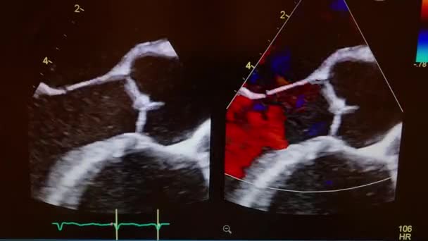 Doppler Echo Aortic Valve Showing Flow Jets Color — Stock Video