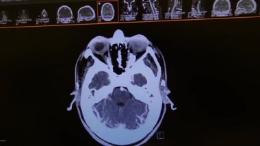 CT Brain angiography - transverse image - black, white