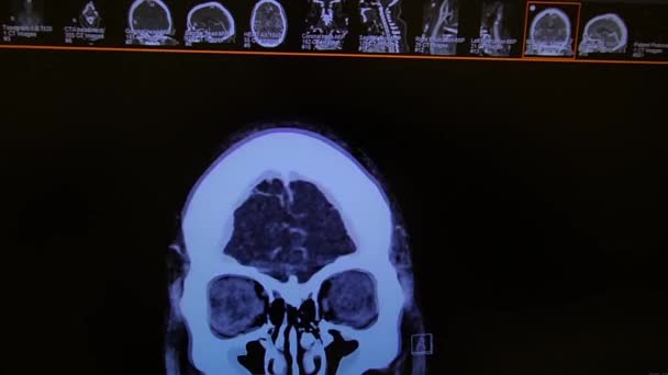 Brain Angiography Coronal Image Black White — Αρχείο Βίντεο