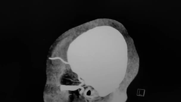 Brain Angiography Sagittal Image Black White — Vídeo de Stock