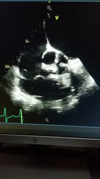Ecocardiograma Coração Pulsante Múltiplos Folhetos Válvulas — Vídeo de Stock