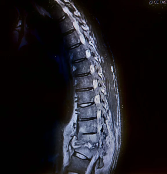 Vertebrální Osteomyelitida Diskovým Abscesem Epidurální Hlenmon — Stock fotografie