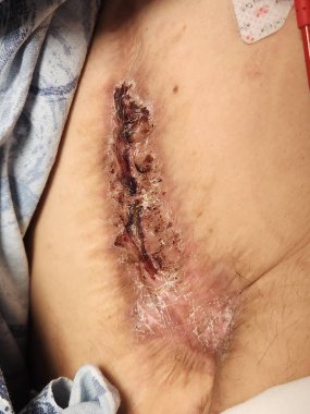 Psikiyatrik sorunları olan hastalarda şiddetli karın duvarı çıkarmaları.