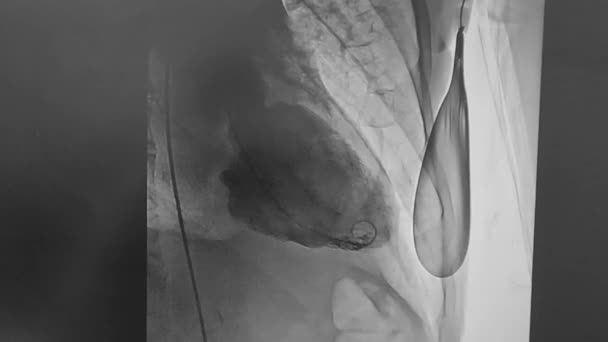 Cardiac Catheterization Video Left Ventricular Filling Ejection — Stock Video