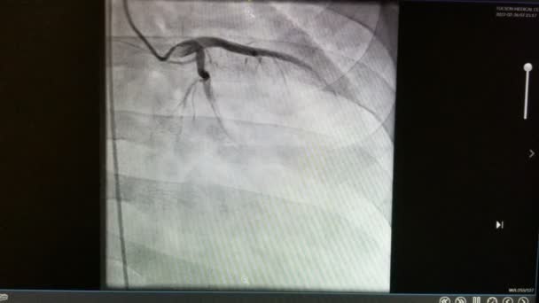 Vídeo Cateterismo Cardíaco Arteria Coronaria Izquierda — Vídeo de stock