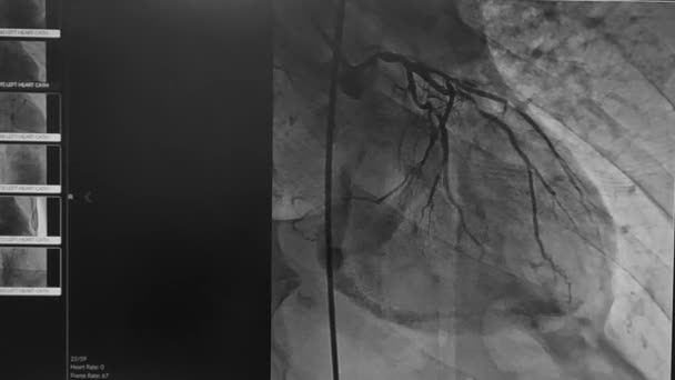 Cardiale Katheterisatie Video Linker Kransslagader — Stockvideo