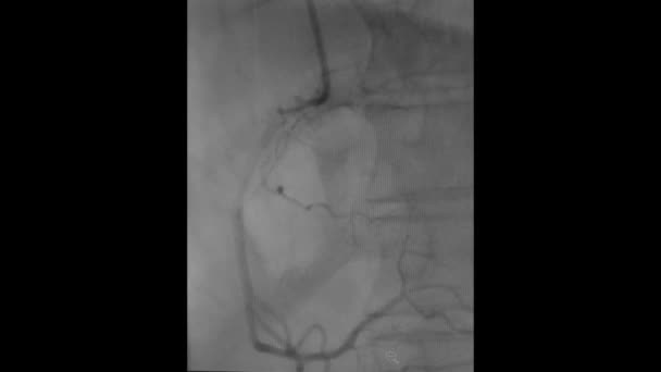 Vídeo Cateterismo Cardíaco Arteria Coronaria Derecha — Vídeos de Stock