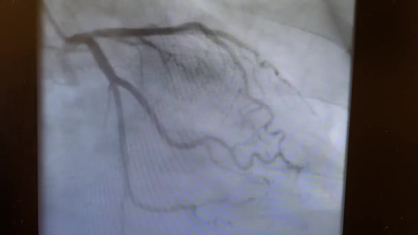 Καρδιακός Καθετηριασμός Βίντεο Αριστερή Στεφανιαία Αρτηρία — Αρχείο Βίντεο