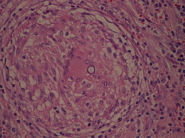 Coccidioides Imitis Σφαιρικό Εσωτερικό Κοκκίωμα Κηλίδα Ιστού — Φωτογραφία Αρχείου