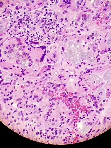 Doku Biyopsisi Numunesinde Coccidioides Imitis Küreleri — Stok fotoğraf