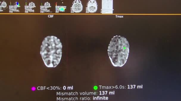 Obrazowanie Perfuzji Mózgu Angiografia Mózgu Kolor — Wideo stockowe