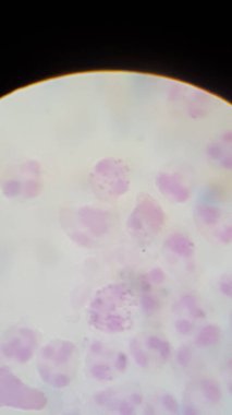 Neisseria gonorrhea on Gram stain - intracellular Gram negative diplococci clipart