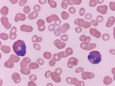 Eosinophils with RBCs on blood smear clipart