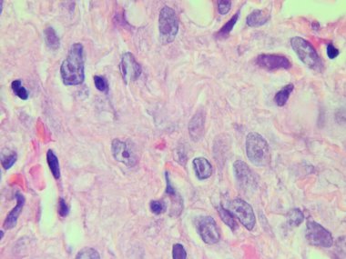 Akciğer dokusu patolojisinde sitomegalovirüs entegrasyonu görüldü