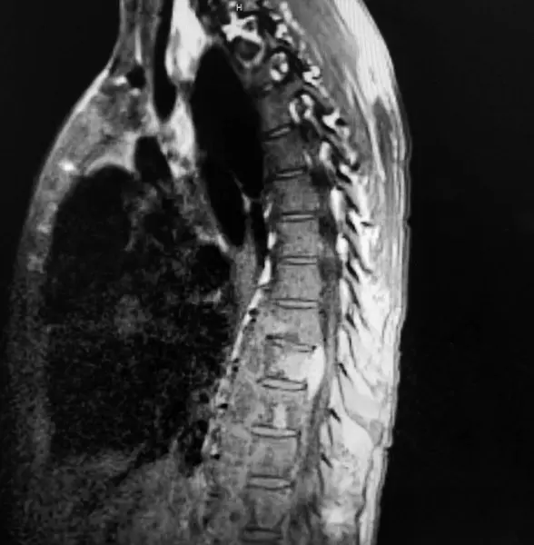stock image Coccidioides vertebral osteomyelitis - diagnostic imaging study