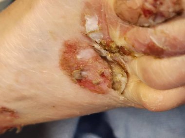 Boğa pemphigoid deri lezyonları - hastaların ön kolları
