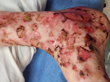Bullous pemphigoid deri lezyonları - hastaların ayakları ve ayak bilekleri