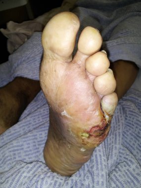 Ayak parmağı ampütasyonu ve sol ayak ülseri belgeleri.
