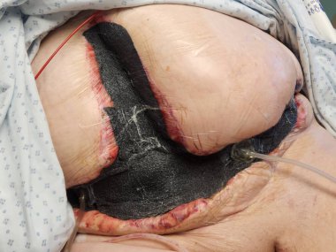 Ameliyattan sonra süpürülmüş.