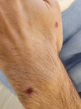 Maymun çiçeği, beyaz eşcinsel erkeklerde deri lezyonları yaydı.