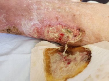 Stafilokok apsesi, ülser ve selülit, sarı irin.