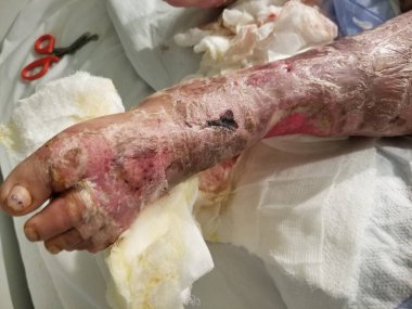 Ayak ve bacak derisi desquamasyonu olan streptokok enfeksiyonu çözülüyor.