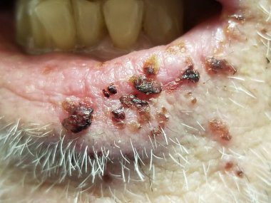 Herpes simplex labialis deri lezyonları