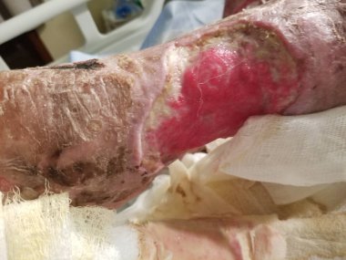 Şiddetli yumuşak doku kaybı. Streptokok enfeksiyonlu ısırık yarası.