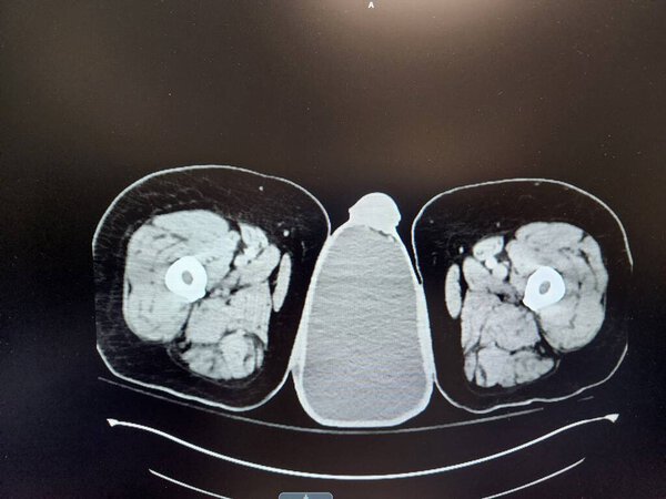 Hydrocele seen - CT scan of pelvis